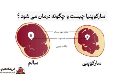 سارکوپنیا چیست و چگونه درمان می شود ؟