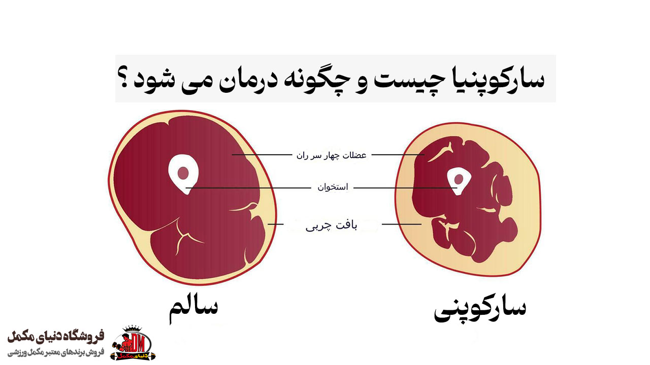 سارکوپنیا چیست و چگونه درمان می شود ؟