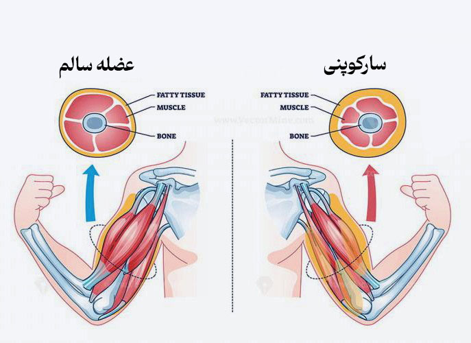 عوامل بیماری سارکوپنیا