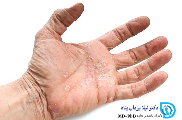 دلایل اصلی خشکی پوست در ناحیه دست‌ها: