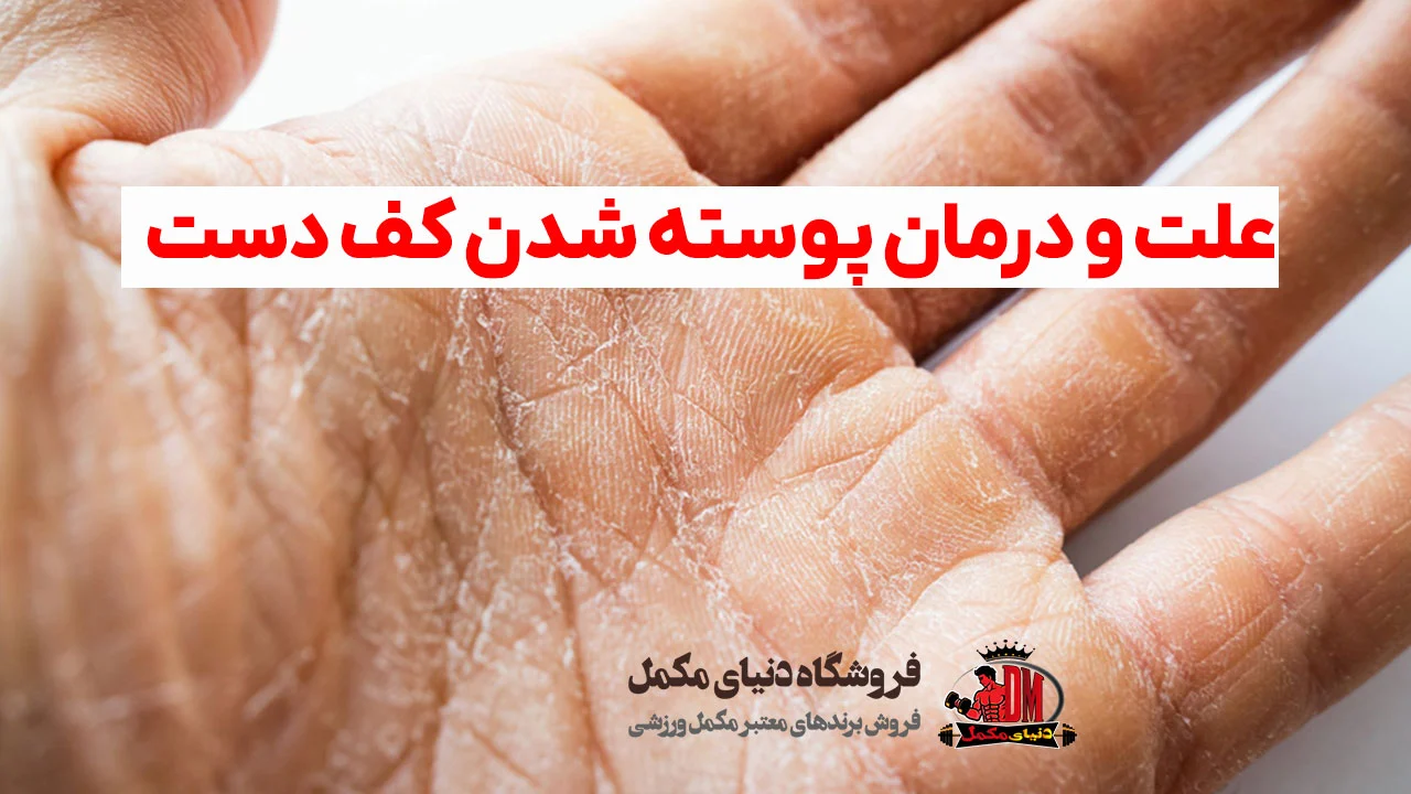 علت و درمان پوسته شدن کف دست