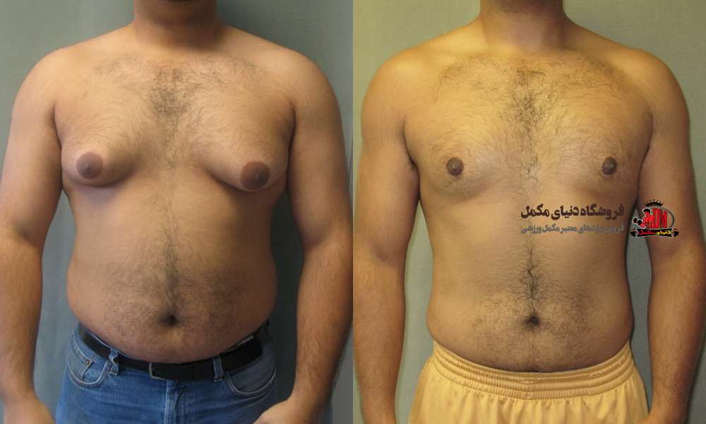 پیشگیری از ژنیکوماستی در بدنسازی